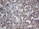 TEM1 / CD248 Antibody - Immunohistochemical staining of paraffin-embedded Carcinoma of Human liver tissue using anti-CD248 mouse monoclonal antibody. (Heat-induced epitope retrieval by 1mM EDTA in 10mM Tris buffer. (pH8.5) at 120°C for 3 min. (1:150)