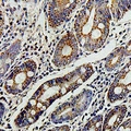 TERE1 / UBIAD1 Antibody - Immunohistochemical analysis of TERE1 staining in human colon cancer formalin fixed paraffin embedded tissue section. The section was pre-treated using heat mediated antigen retrieval with sodium citrate buffer (pH 6.0). The section was then incubated with the antibody at room temperature and detected using an HRP conjugated compact polymer system. DAB was used as the chromogen. The section was then counterstained with hematoxylin and mounted with DPX.
