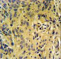 TESC Antibody - TESC Antibody IHC of formalin-fixed and paraffin-embedded human lung carcinoma followed by peroxidase-conjugated secondary antibody and DAB staining.
