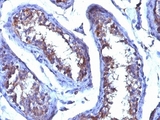 Testosterone Antibody - Formalin-fixed. Paraffin-embedded human testicular carcinoma stained with Testosterone antibody (4E1G2) This image was taken for the unmodified form of this product. Other forms have not been tested.