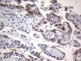 TET3 Antibody - IHC of paraffin-embedded Adenocarcinoma of Human ovary tissue using anti-TET3 mouse monoclonal antibody. (Heat-induced epitope retrieval by 1 mM EDTA in 10mM Tris, pH8.5, 120°C for 3min).