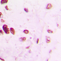 Antibody - Immunohistochemical analysis of AP2 alpha/beta staining in human lung cancer formalin fixed paraffin embedded tissue section. The section was pre-treated using heat mediated antigen retrieval with sodium citrate buffer (pH 6.0). The section was then incubated with the antibody at room temperature and detected using an HRP conjugated compact polymer system. DAB was used as the chromogen. The section was then counterstained with hematoxylin and mounted with DPX.
