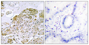 TFEB Antibody - Immunohistochemistry analysis of paraffin-embedded human lung carcinoma tissue, using TFEB Antibody. The picture on the right is blocked with the synthesized peptide.