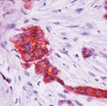 TFF1 / pS2 Antibody - Formalin-fixed, paraffin-embedded human breast cancer stained with peroxidase-conjugate and AEC chromogen. Note cytoplasmic staining of tumor cells.  This image was taken for the unmodified form of this product. Other forms have not been tested.