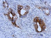 TFF1 / pS2 Antibody - IHC of paraffin-embedded Gastric ca, using Trefoil factor 1 antibody at 1:500 dilution.