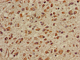 TGDS Antibody - Immunohistochemistry of paraffin-embedded human glioma cancer using TGDS Antibody at dilution of 1:100