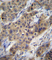 TGFB1 / TGF Beta 1 Antibody - TGFB1 Antibody immunohistochemistry of formalin-fixed and paraffin-embedded human breast carcinoma followed by peroxidase-conjugated secondary antibody and DAB staining.
