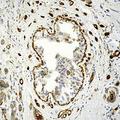 TGM2 / Transglutaminase 2 Antibody - Formalin-fixed, paraffin-embedded human breast carcinoma stained with Transglutaminase II antibody.