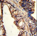 TGM4 / Transglutaminase 4 Antibody - Formalin-fixed and paraffin-embedded human prostate carcinoma with TGM4 Antibody , which was peroxidase-conjugated to the secondary antibody, followed by DAB staining. This data demonstrates the use of this antibody for immunohistochemistry; clinical relevance has not been evaluated.
