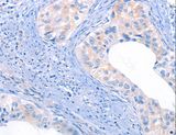 THBS1 / Thrombospondin-1 Antibody - Immunohistochemistry of paraffin-embedded Human cervical cancer using THBS1 Polyclonal Antibody at dilution of 1:50.