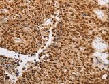 THOC7 Antibody - Immunohistochemistry of paraffin-embedded Human lung cancer using THOC7 Polyclonal Antibody at dilution of 1:30.