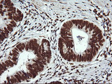 THUMPD1 Antibody - IHC of paraffin-embedded Carcinoma of Human pancreas tissue using anti-THUMPD1 mouse monoclonal antibody.