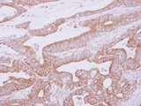 THUMPD2 Antibody - IHC of paraffin-embedded Colon ca, using THUMPD2 antibody at 1:500 dilution.