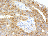 thyA / Thymidylate Synthetase Antibody - Thymidylate Synthase on Cervical Cancer