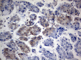 TIA-1 Antibody - IHC of paraffin-embedded Carcinoma of Human liver tissue using anti-TIA1 mouse monoclonal antibody.