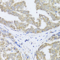 TIMM10B / FXC1 Antibody - Immunohistochemistry of paraffin-embedded human liver cancer tissue.