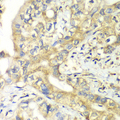TIMM17A / TIM17 Antibody - Immunohistochemistry of paraffin-embedded human liver cancer tissue.