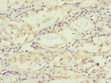 TIMM17B Antibody - Immunohistochemistry of paraffin-embedded human gastric cancer at dilution of 1:100