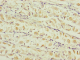 TIMM17B Antibody - Immunohistochemistry of paraffin-embedded human gastric cancer at dilution of 1:100