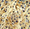 TIMP1 Antibody - Formalin-fixed and paraffin-embedded human breast carcinoma reacted with TIMP1 Antibody , which was peroxidase-conjugated to the secondary antibody, followed by DAB staining. This data demonstrates the use of this antibody for immunohistochemistry; clinical relevance has not been evaluated.