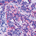 TIMP2 Antibody - Formalin-fixed, paraffin-embedded human pancreatic tumor stained with peroxidase-conjugate and AEC chromogen. Note cytoplasmic staining of tumor cells. This image was taken for the unmodified form of this product. Other forms have not been tested.