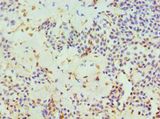 TIP30 / HTATIP2 Antibody - Immunohistochemistry of paraffin-embedded human breast cancer using antibody at 1:100 dilution.