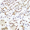 TIP49 / RUVBL1 Antibody - Immunohistochemical analysis of Pontin 52 staining in human gastric cancer formalin fixed paraffin embedded tissue section. The section was pre-treated using heat mediated antigen retrieval with sodium citrate buffer (pH 6.0). The section was then incubated with the antibody at room temperature and detected using an HRP conjugated compact polymer system. DAB was used as the chromogen. The section was then counterstained with hematoxylin and mounted with DPX.