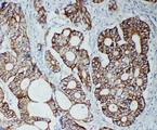 TJP2 / ZO2 / ZO-2 Antibody - TJP2 / ZO2 / ZO-2 antibody. IHC(P): Human Intestinal Cancer Tissue.