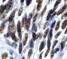 TLE1 / TLE 1 Antibody - IHC of TLE1 on FFPE Synovial Sarcoma tissue.