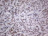 TLK2 Antibody - IHC of paraffin-embedded Adenocarcinoma of Human endometrium tissue using anti-TLK2 mouse monoclonal antibody. (Heat-induced epitope retrieval by 1 mM EDTA in 10mM Tris, pH8.5, 120°C for 3min).