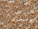 TLN1 / Talin 1 Antibody - Immunohistochemistry of paraffin-embedded Human liver cancer using TLN1 Polyclonal Antibody at dilution of 1:30.