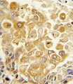 TLR2 Antibody - Formalin-fixed and paraffin-embedded human lung carcinoma tissue reacted with TLR2 antibody , which was peroxidase-conjugated to the secondary antibody, followed by DAB staining. This data demonstrates the use of this antibody for immunohistochemistry; clinical relevance has not been evaluated.