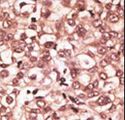 TLR6 Antibody - Formalin-fixed and paraffin-embedded human cancer tissue reacted with the primary antibody, which was peroxidase-conjugated to the secondary antibody, followed by AEC staining. This data demonstrates the use of this antibody for immunohistochemistry; clinical relevance has not been evaluated. BC = breast carcinoma; HC = hepatocarcinoma.