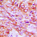 TMBIM1 Antibody - Immunohistochemical analysis of TMBIM1 staining in human breast cancer formalin fixed paraffin embedded tissue section. The section was pre-treated using heat mediated antigen retrieval with sodium citrate buffer (pH 6.0). The section was then incubated with the antibody at room temperature and detected using an HRP-conjugated compact polymer system. DAB was used as the chromogen. The section was then counterstained with hematoxylin and mounted with DPX.