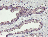 TMEFF2 Antibody - IHC of paraffin-embedded Carcinoma of Human prostate tissue using anti-TMEFF2 mouse monoclonal antibody. (Heat-induced epitope retrieval by 10mM citric buffer, pH6.0, 100C for 10min).