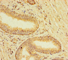 TMEM120B Antibody - Immunohistochemistry of paraffin-embedded human prostate cancer using TMEM120B Antibody at dilution of 1:100