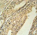 TMEM134 Antibody - TMEM134 Antibody immunohistochemistry of formalin-fixed and paraffin-embedded human prostate carcinoma followed by peroxidase-conjugated secondary antibody and DAB staining.