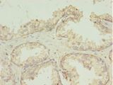TMEM141 Antibody - Immunohistochemistry of paraffin-embedded human prostate cancer using antibody at 1: 100 dilution.  This image was taken for the unconjugated form of this product. Other forms have not been tested.