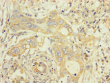 TMEM184B Antibody - Immunohistochemistry of paraffin-embedded human pancreatic cancer using TMEM184B Antibody at dilution of 1:100