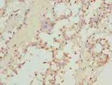 TMEM19 Antibody - Immunohistochemistry of paraffin-embedded human breast cancer using antibody at dilution of 1:100.