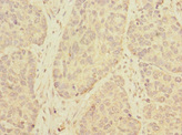TMEM209 Antibody - Immunohistochemistry of paraffin-embedded human ovarian cancer using TMEM209 Antibody at dilution of 1:100