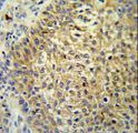 TMEM222 Antibody - TM222 Antibody IHC of formalin-fixed and paraffin-embedded bladder carcinoma followed by peroxidase-conjugated secondary antibody and DAB staining.
