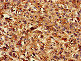 TMEM43 Antibody - Immunohistochemistry of paraffin-embedded human melanoma cancer at dilution of 1:100
