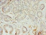 TMEM45A Antibody - Immunohistochemistry of paraffin-embedded human breast cancer using antibody at dilution of 1:100.