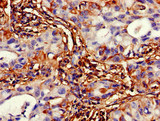 TMEM49 Antibody - Immunohistochemistry of paraffin-embedded human lung cancer at dilution of 1:100