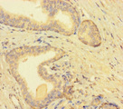 TMEM52B / C12orf59 Antibody - Immunohistochemistry of paraffin-embedded human prostate cancer using TMEM52B Antibody at dilution of 1:100