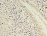 TMEM55A Antibody - Immunohistochemistry of paraffin-embedded human lung cancer using antibody at dilution of 1:100.