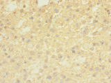 TMEM56 Antibody - Immunohistochemistry of paraffin-embedded human glioma using TMEM56 Antibody at dilution of 1:100