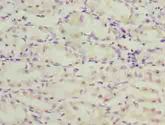 TMEM71 Antibody - Immunohistochemistry of paraffin-embedded human gastric cancer using antibody at dilution of 1:100.