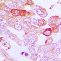 TNFAIP3 / A20 Antibody - Immunohistochemical analysis of A20 staining in human lung cancer formalin fixed paraffin embedded tissue section. The section was pre-treated using heat mediated antigen retrieval with sodium citrate buffer (pH 6.0). The section was then incubated with the antibody at room temperature and detected using an HRP conjugated compact polymer system. DAB was used as the chromogen. The section was then counterstained with hematoxylin and mounted with DPX.
